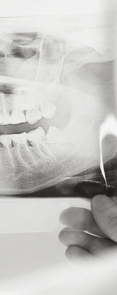 X-ray of wisdom tooth