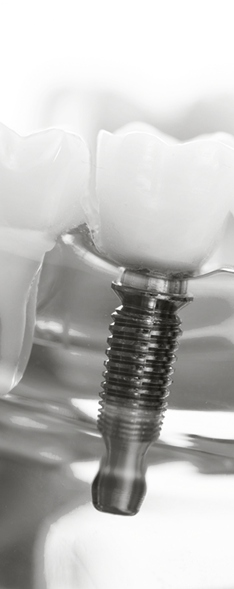 Dental implant